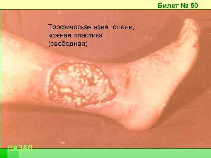 Билет № 50 Трофическая язва голени, кожная пластика (свободная) НАЗАД 