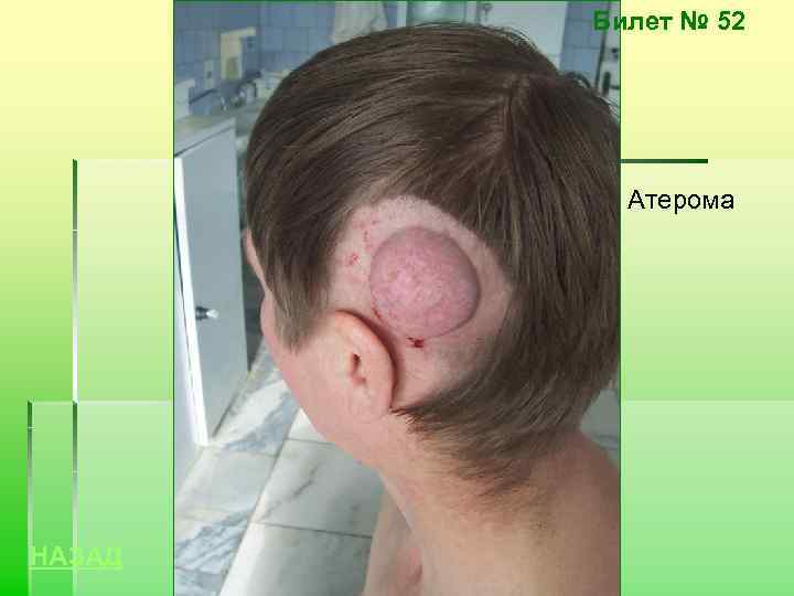 Билет № 52 Атерома НАЗАД 