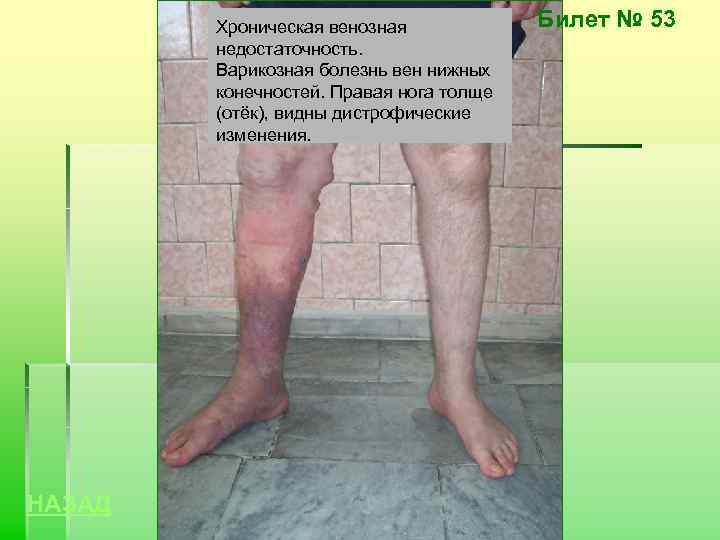 Хроническая венозная недостаточность. Варикозная болезнь вен нижных конечностей. Правая нога толще (отёк), видны дистрофические