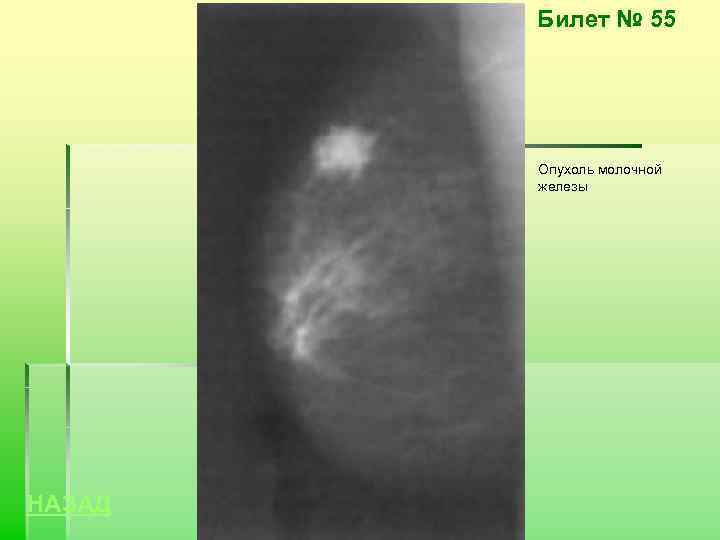 Билет № 55 Опухоль молочной железы НАЗАД 