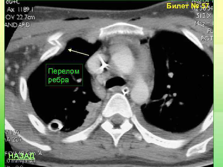 Билет № 57 Перелом ребра НАЗАД 