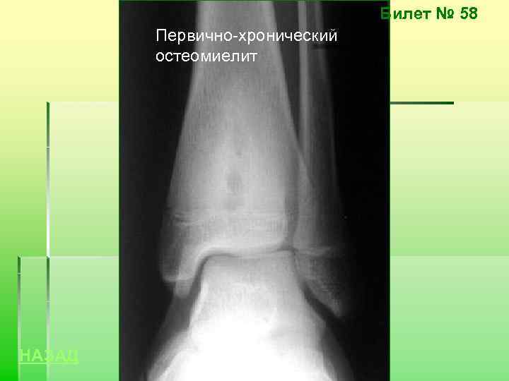 Билет № 58 Первично-хронический остеомиелит НАЗАД 