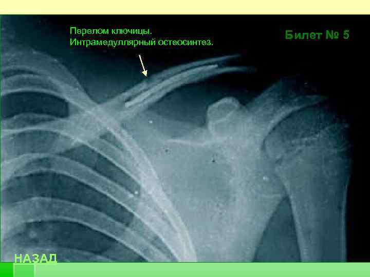 Перелом ключицы. Интрамедуллярный остеосинтез. НАЗАД Билет № 5 
