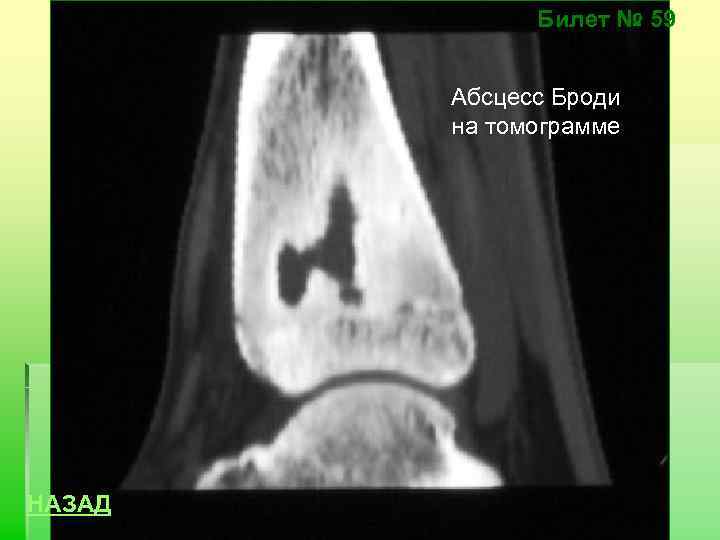 Билет № 59 Абсцесс Броди на томограмме НАЗАД 