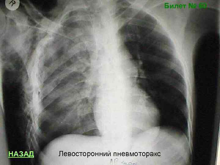 Билет № 60 НАЗАД Левосторонний пневмоторакс 