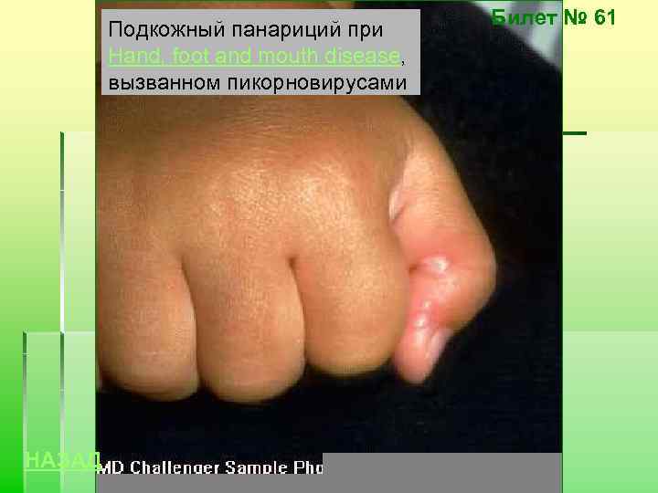 Подкожный панариций при Hand, foot and mouth disease, вызванном пикорновирусами НАЗАД Билет № 61