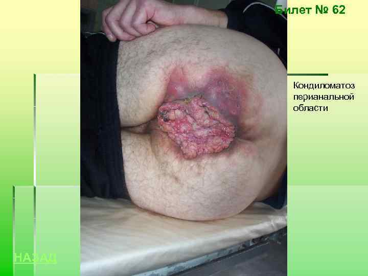 Билет № 62 Кондиломатоз перианальной области НАЗАД 