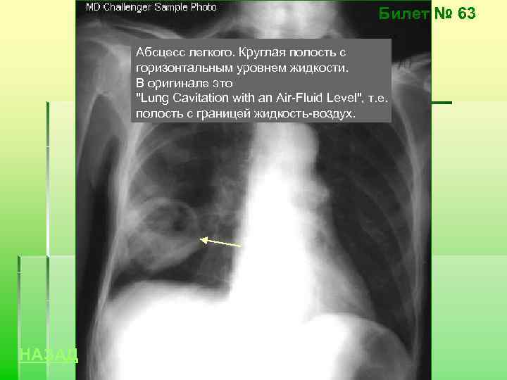 Билет № 63 Абсцесс легкого. Круглая полость с горизонтальным уровнем жидкости. В оригинале это