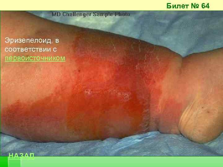 Билет № 64 Эризепелоид, в соответствии с первоисточником НАЗАД 
