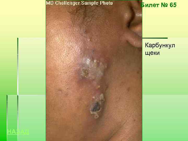 Билет № 65 Карбункул щеки НАЗАД 