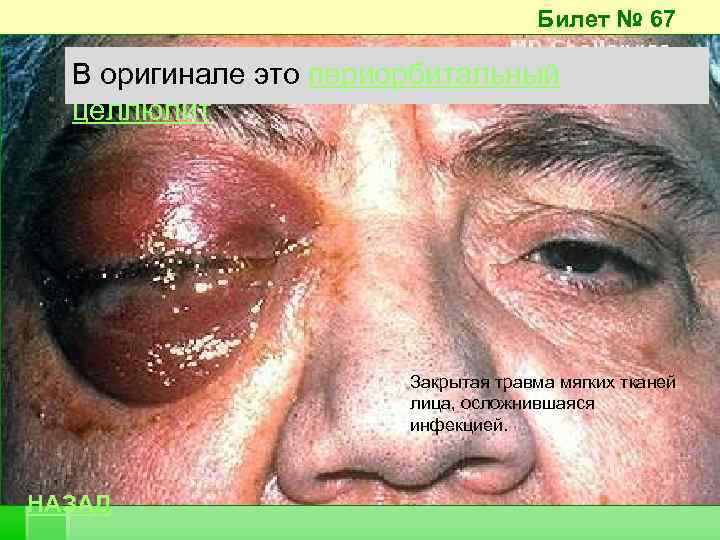 Билет № 67 В оригинале это периорбитальный целлюлит Закрытая травма мягких тканей лица, осложнившаяся