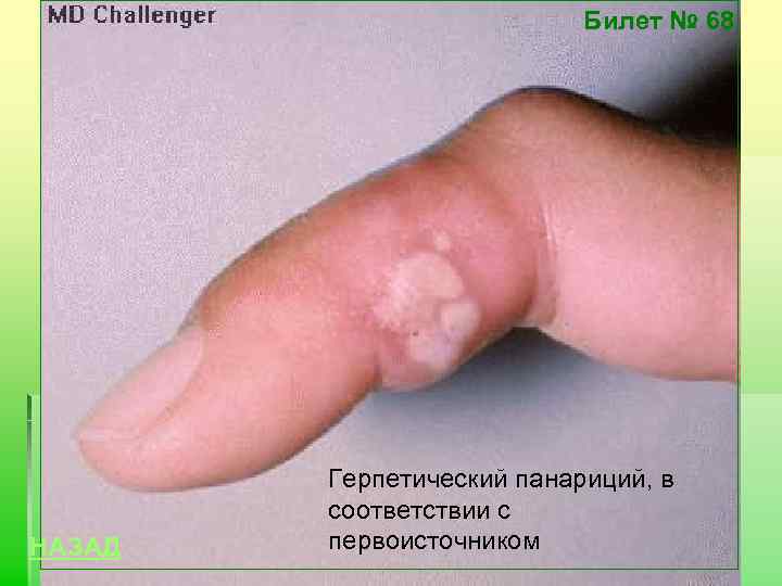 Билет № 68 НАЗАД Герпетический панариций, в соответствии с первоисточником 