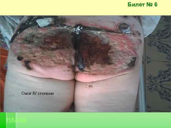 Билет № 6 Ожог IV степени НАЗАД 