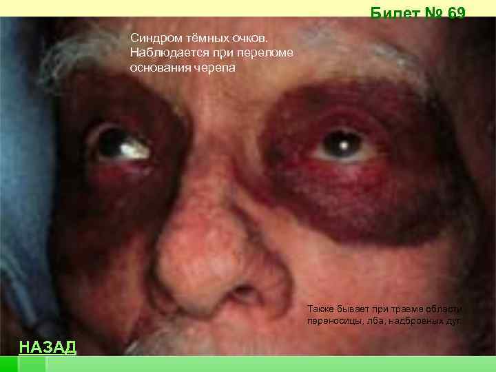 Билет № 69 Синдром тёмных очков. Наблюдается при переломе основания черепа Также бывает при