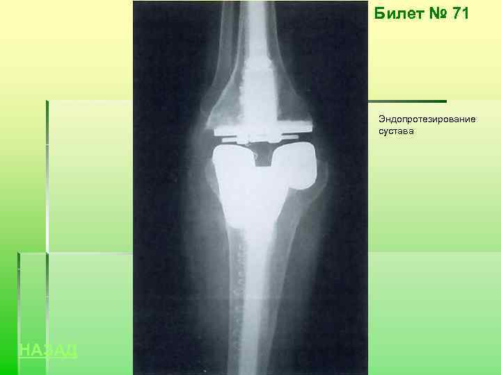 Билет № 71 Эндопротезирование сустава НАЗАД 