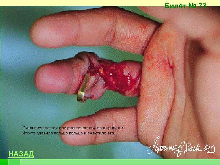 Билет № 73 Скальпированная или рваная рана 4 пальца кисти. Что-то сдавило кольцо и
