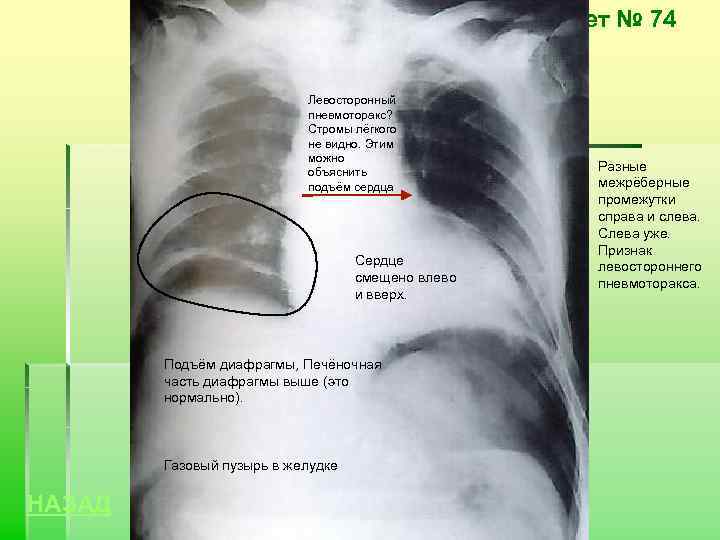 Билет № 74 Левосторонный пневмоторакс? Стромы лёгкого не видно. Этим можно объяснить подъём сердца