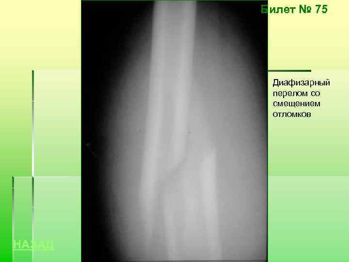 Билет № 75 Диафизарный перелом со смещением отломков НАЗАД 