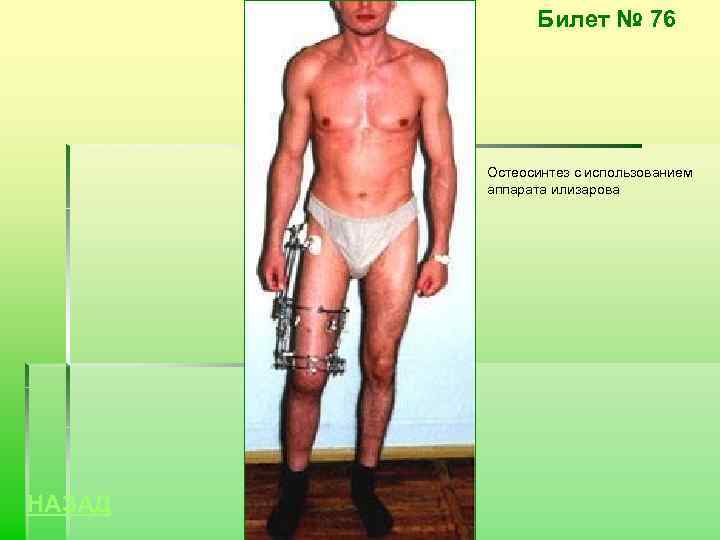 Билет № 76 Остеосинтез с использованием аппарата илизарова НАЗАД 