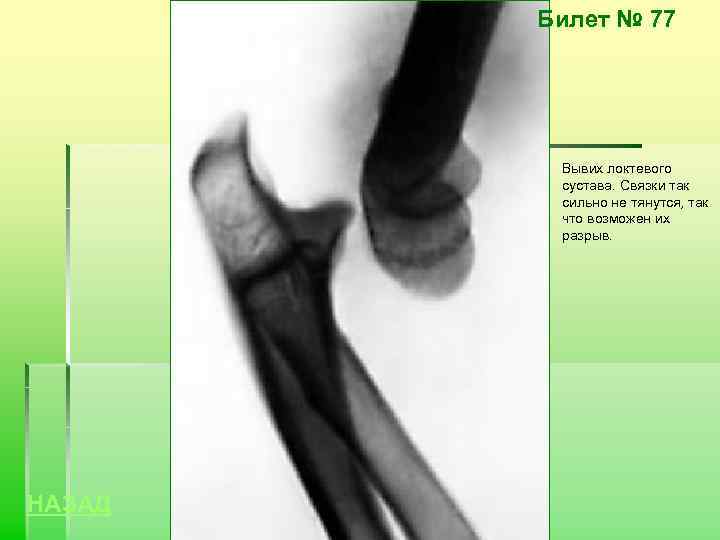 Билет № 77 Вывих локтевого сустава. Связки так сильно не тянутся, так что возможен