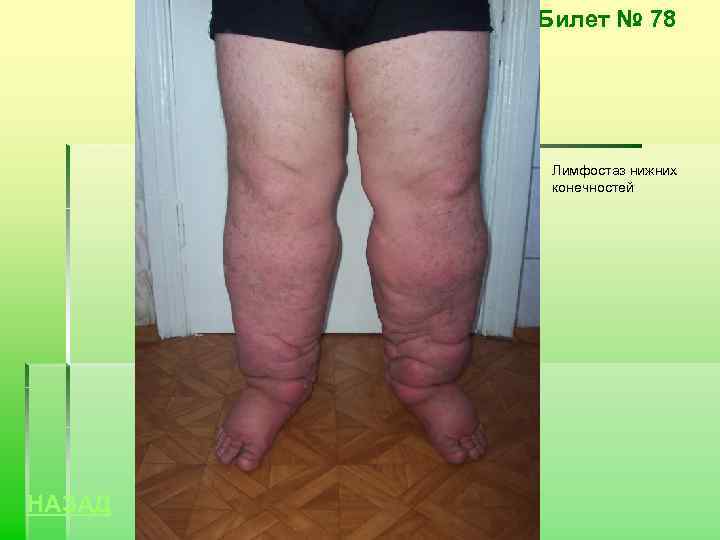 Билет № 78 Лимфостаз нижних конечностей НАЗАД 