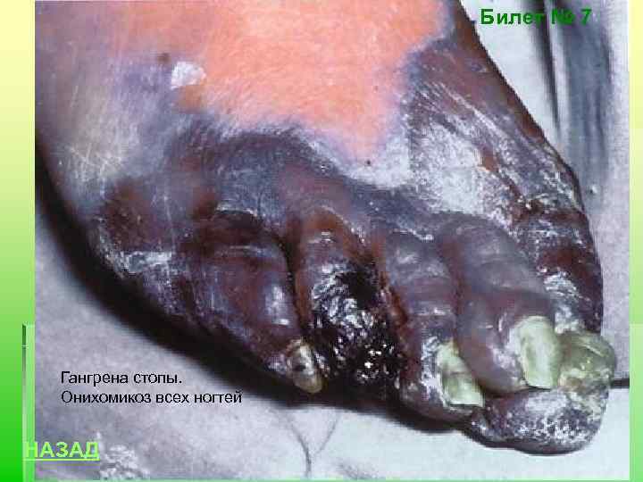 Билет № 7 Гангрена стопы. Онихомикоз всех ногтей НАЗАД 