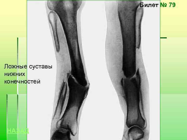 Билет № 79 Ложные суставы нижних конечностей НАЗАД 