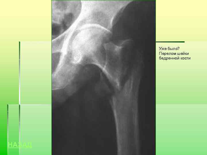Уже было? Перелом шейки бедренной кости НАЗАД 