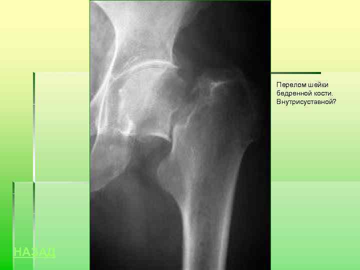 Перелом шейки бедренной кости. Внутрисуставной? НАЗАД 