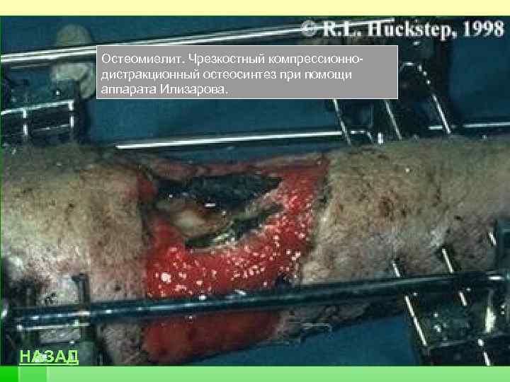 Остеомиелит. Чрезкостный компрессионнодистракционный остеосинтез при помощи аппарата Илизарова. НАЗАД 