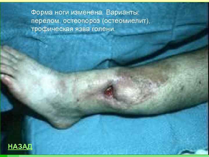 Форма ноги изменена. Варианты: перелом, остеопороз (остеомиелит), трофическая язва голени. НАЗАД 