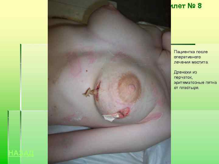 Билет № 8 Пациентка после оперативного лечения мастита. Дренажи из перчаток, эритематозные пятна от