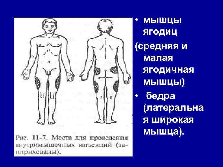  • мышцы ягодиц (средняя и малая ягодичная мышцы) • бедра (латеральна я широкая