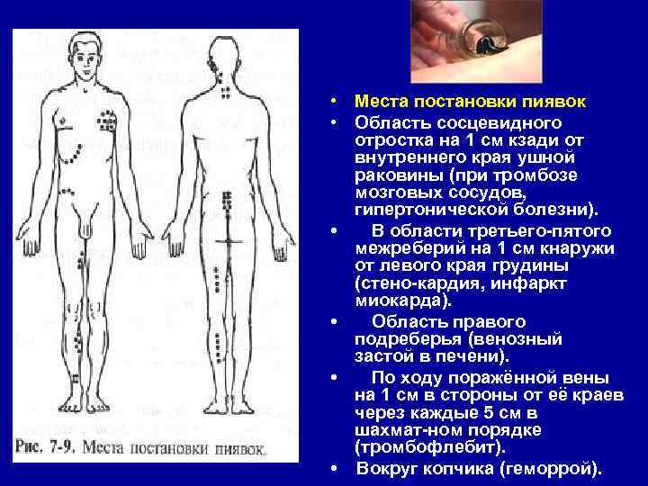 Постановка пиявок при гипертонии схема