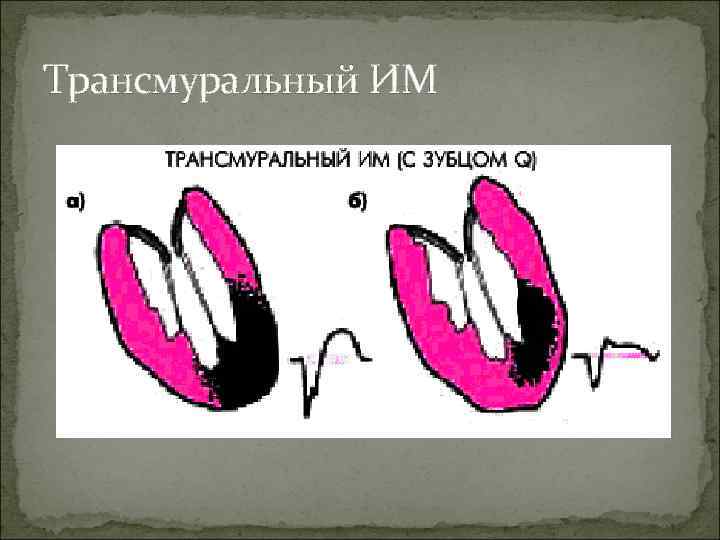 Трансмуральный ИМ 