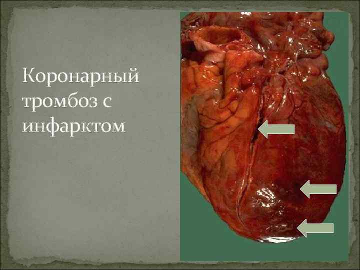 Коронарный тромбоз с инфарктом 