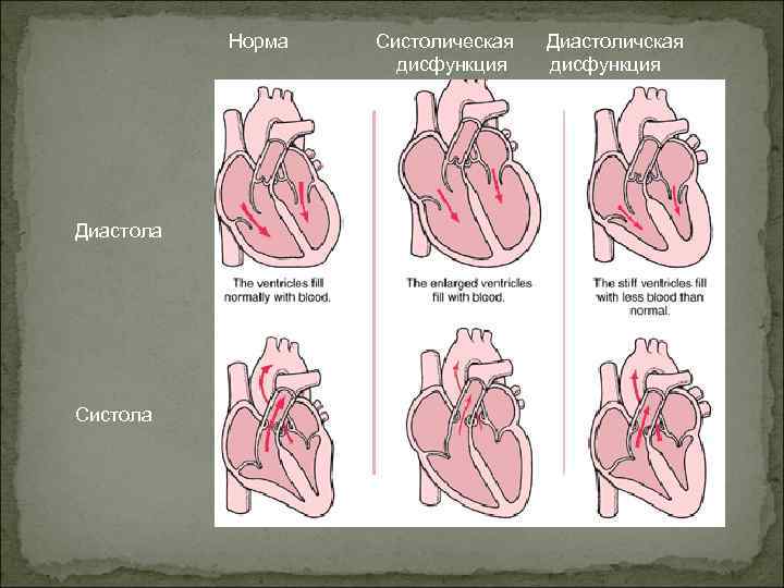 Норма Диастола Систолическая дисфункция Диастоличская дисфункция 