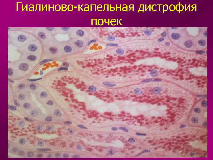 Гиалиново-капельная дистрофия почек 