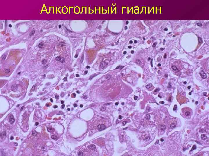 Алкогольный гиалин 