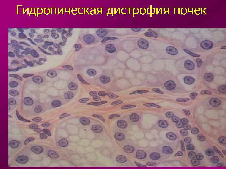 Гидропическая дистрофия почек 