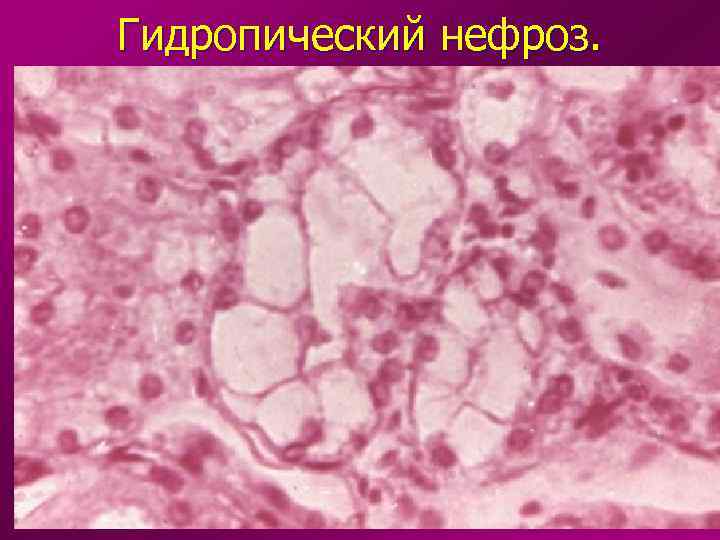 Гидропический нефроз. 