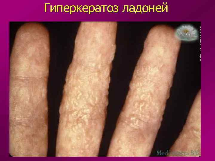 Гиперкератоз ладоней 