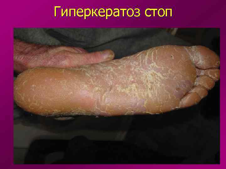 Гиперкератоз стоп 