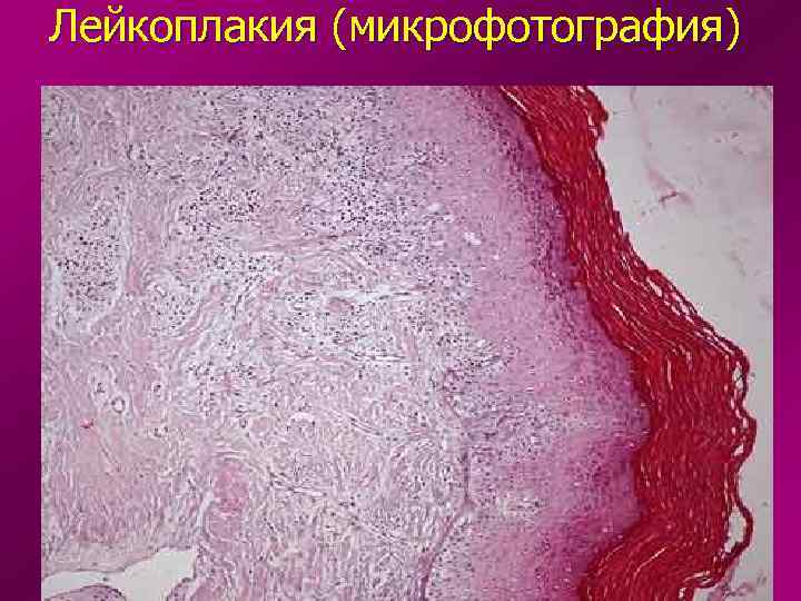 Лейкоплакия (микрофотография) 