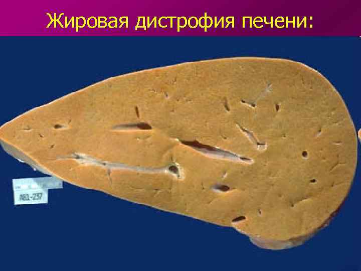 Жировая дистрофия печени: 