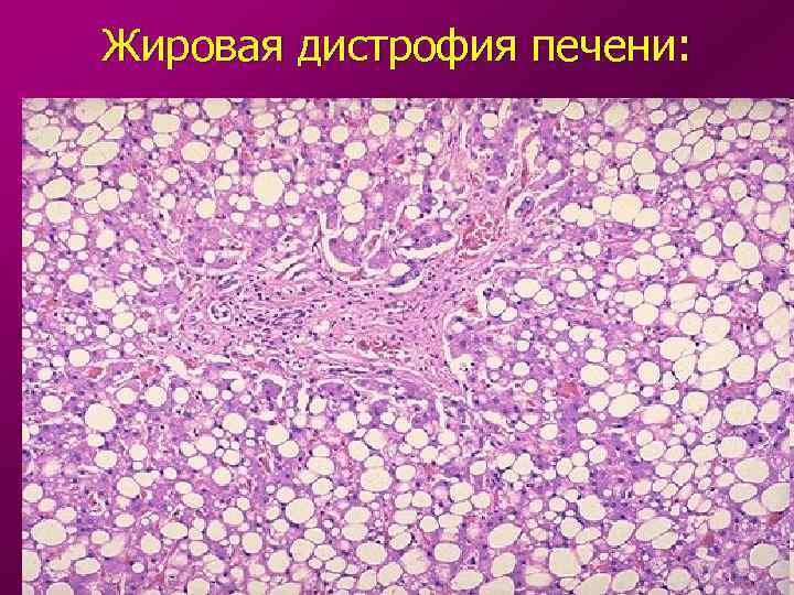 Жировая дистрофия печени: 