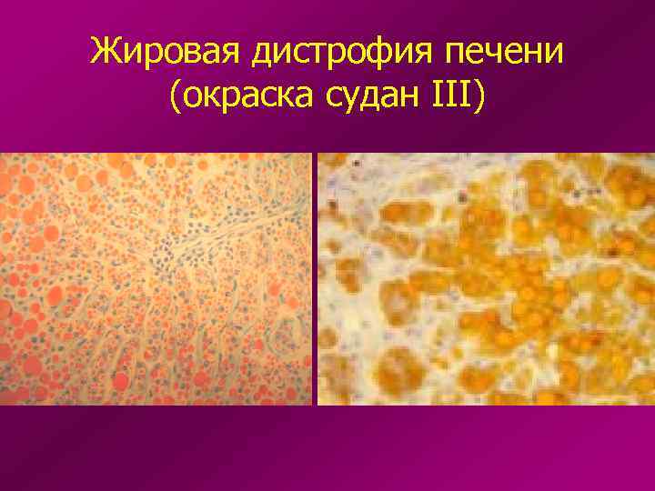 Жировая дистрофия печени (окраска судан III) 