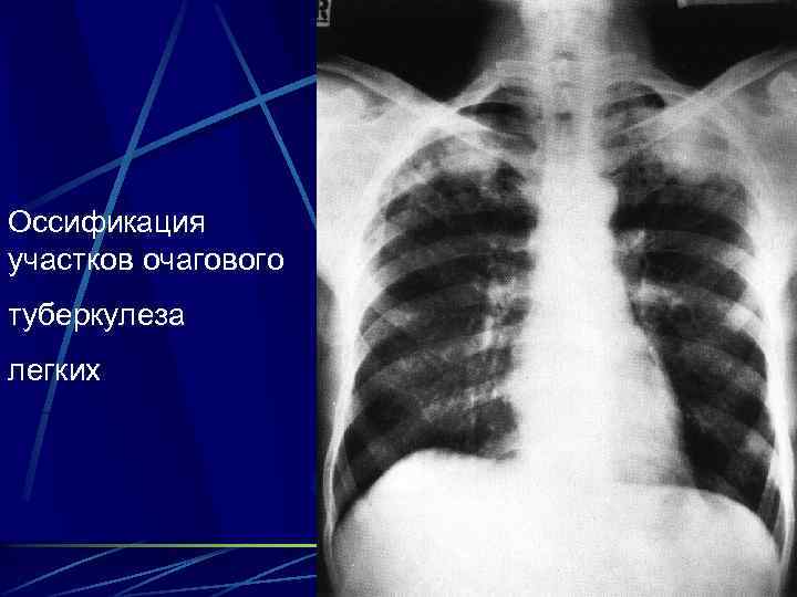 Оссификация участков очагового туберкулеза легких 