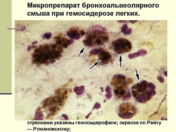 Микропрепарат бронхоальвеолярного смыва при гемосидерозе легких. стрелками указаны гемосидерофаги; окраска по Райту — Романовскому;