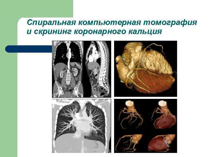 Спиральная компьютерная томография и скрининг коронарного кальция 